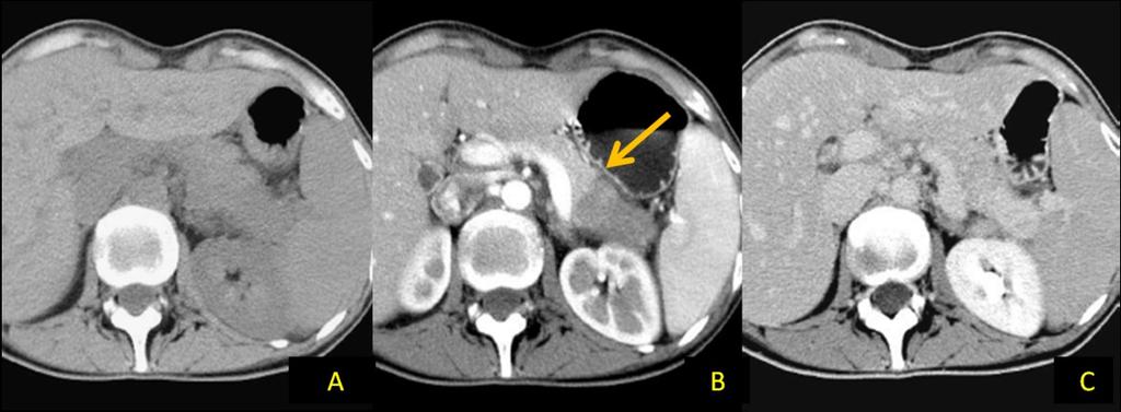 11: 43-y-old woman with autoimmune pancreatitis of the tail. Unenhanced CT image (A) demonstrates a swollen pancreatic tail which appears slightly hypodense.