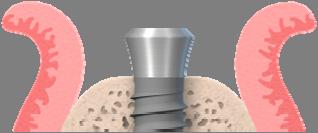 Bone-level implant a key launch to offer