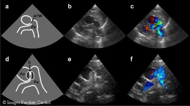 Introduction Aortopulmonary window is a rare congenital cardiac malformation that typically requires surgical treatment.