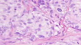 Langerhans Cell Sarcoma Exceptionally rare High grade neoplasm with overtly