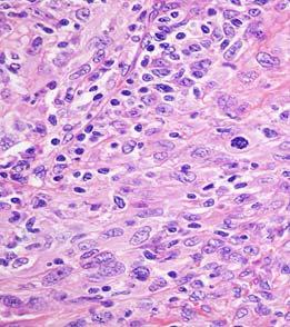 Interdigitating Dendritic Cell Sarcoma: Histology
