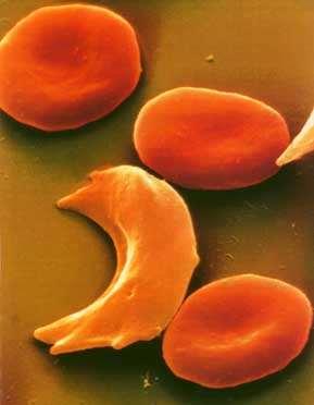 Sickle-Cell Disease An example of codominance in humans Common in African Americans and Americans with ancestry near the Mediterranean Sea Homozygous