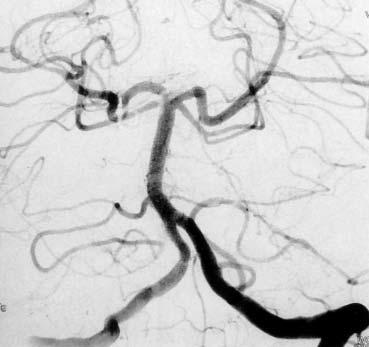 artery, the right-sided posterior cerebral artery and the anterior view of the aneurismal package and sack.