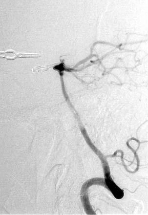 637 Figure 10. Lateral angiogram of the spine reveals one aneurysm of the basilar artery apex projected anterior wise () clipped (). Post-op patient evolution was excellent.