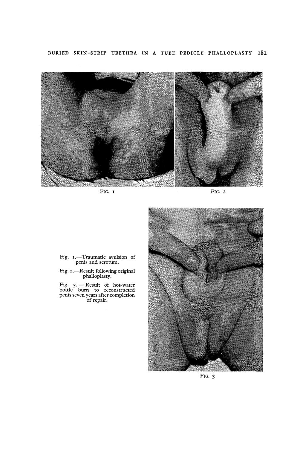 BURIED SKIN-STRIP URETHRA IN A TUBE PEDICLE PHALLOPLASTY 281 Fie. x Fro. 2 Fig. I.--Traumatic avulsion of penis and scrotum. Fig. 2.--Result following original phalloplasty.