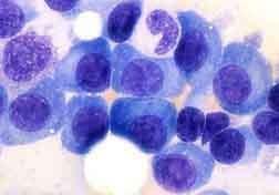 Multiple myeloma (MM) Neoplasm of PLASMA CELLS (Immunoglobulin secreting terminally differentiated end-stage B cells in BM) Older