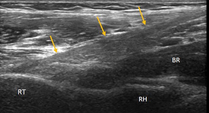 The probe is aligned in an oblique orientation and aimed laterally a few degrees towards the radius. In addition the probe maybe toed-in distally to allow better visualisation of the biceps tendon.
