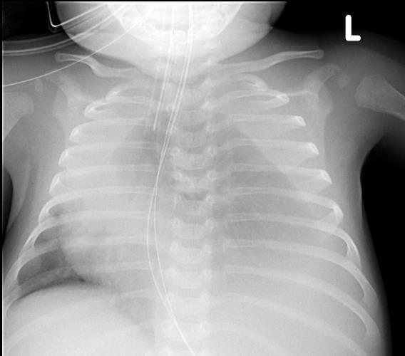 Intrathoracic mass in a neonate