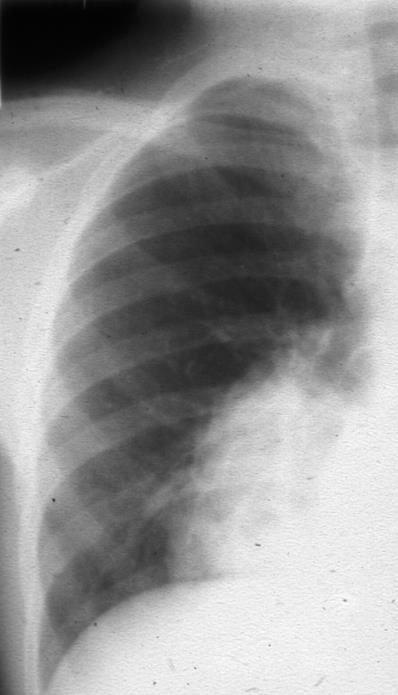 Chestfilm shows consolidation, cystic changes