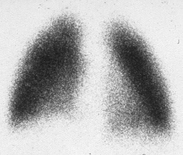 Lung scintigraphy with perfusion defect in