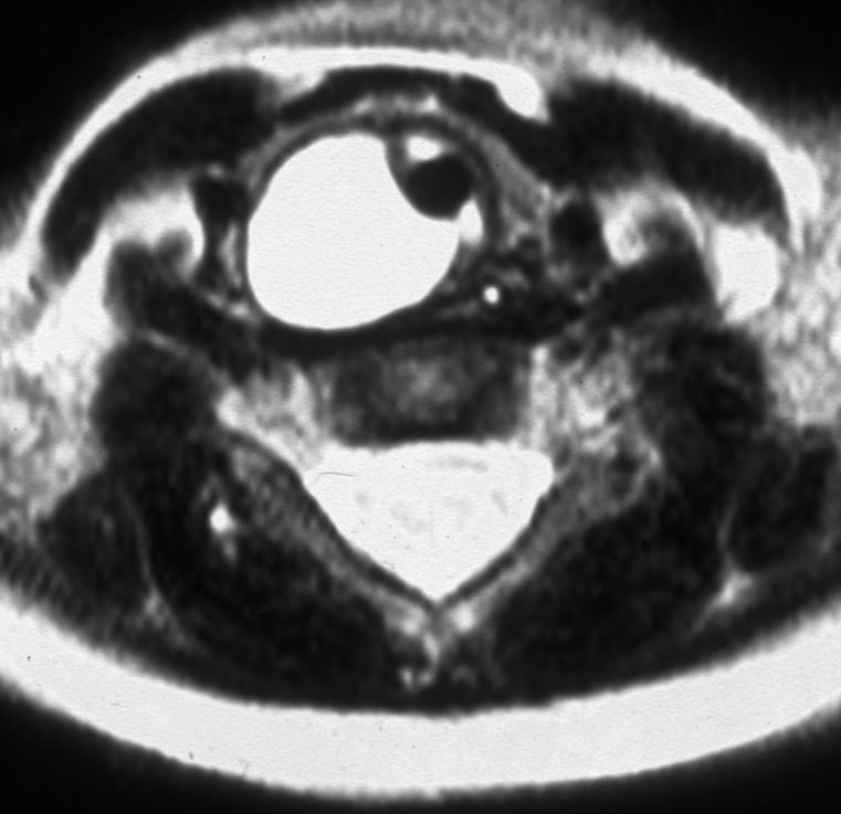 MRI shows duplicated trachea belonging to the mass.