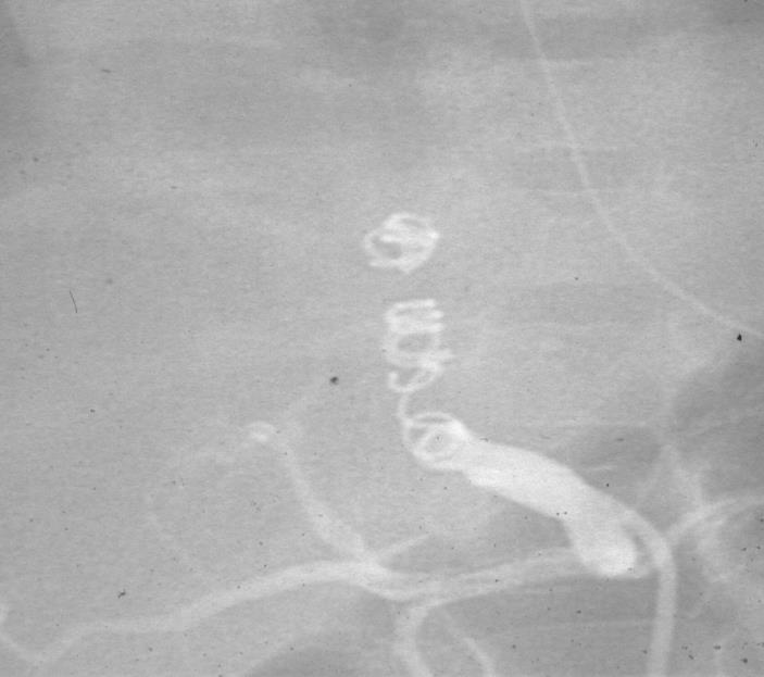 chestfilm and CT angiogram.