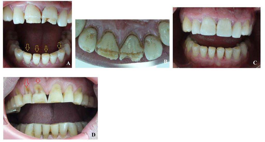 hand, erosion was determined incisal and occlusal surfaces of the mandibular teeth.