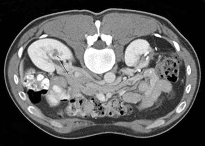Kim et al A B C D Fig. 1. Serial changes of the Von Hippel Lindau (VHL) disease patient. The patient underwent open left partial nephrectomy due to left renal mass on December 2010.