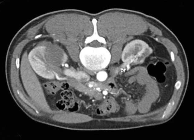 (C) The postoperative CT image at 3 months. The images showed a improved previous cryoablation site in right kidney. (D) The postoperative CT image at 1 year. Table 5.