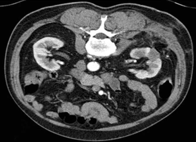 (C) The postoperative CT image showed a recurred tumor in medial aspect of cryoablated lesion in left kidney (arrow). (D) The postradiofrequency ablation CT image at 2 months.