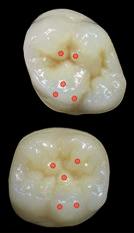 / lower anterior teeth / Primary morphology Primary morphology - Secondary morphology - Secondary morphology abrasive Primary