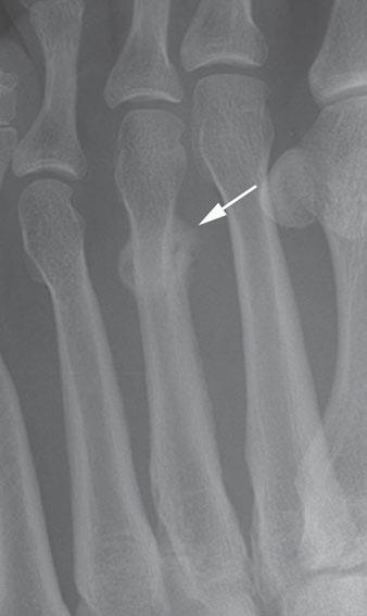 Rana et al. Fracture Periosteal reaction related to fractures can show a solid, nonaggressive appearance or a more disorganized, aggressive appearance (Fig. 14).