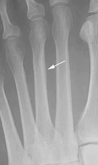 Periosteal reaction from traumatic and pathologic fractures can have a similar appearance.