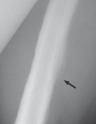 Periosteal Reaction Fig. 15 Osteogenic sarcoma. Lateral radiograph of mid femur shows sunburst periosteal reaction with bone formation in divergent pattern (arrow).