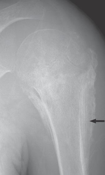 Periosteal reaction due to chondroblastoma most commonly occurs in large lesions in flat or small tubular bones. The periosteal reaction can be thick, solid, or laminated (Fig. 16).