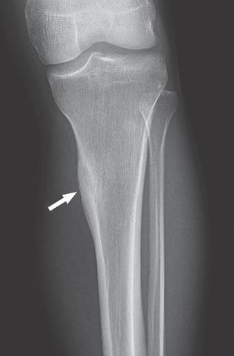 Rana et al. A C Fig. 17 Osteoid osteoma. A, Frontal radiograph of proximal tibia shows smooth, thick periosteal reaction along medial tibia cortex (arrow).