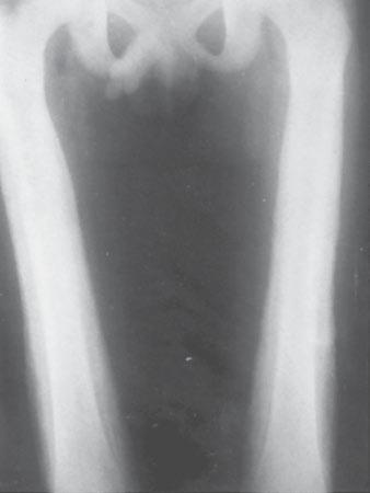 Periosteal Reaction Fig. 18 Leukemia. Frontal radiograph of femurs shows dense thick periosteal reaction along femoral shafts bilaterally. (Reprinted with permission from Eisenberg RL.