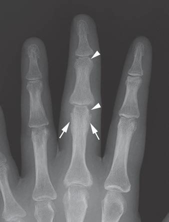 8 Psoriatic arthritis. Frontal radiograph of hand shows thick solid periosteal reaction along proximal phalanx of long finger (arrows).