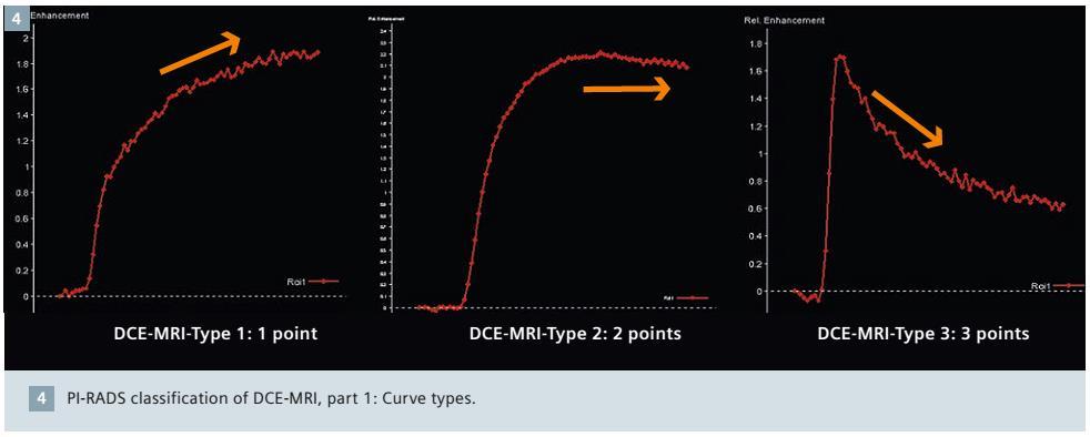 Dünaamiline kontrasteerumine (DCE) PI-RADS v1 on eeldanud, et dünaamilist kontrasteerumist saab hinnata kvantitatiivselt eristatakse kolme tüüpi