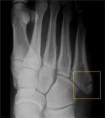 Routinely with each of these fractures, patients are initially able to place variable amounts of weight on the ankle and often walk on it with a limp; however, with the onset of soft tissue swelling