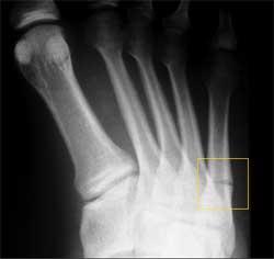 Of the 5 fractures, 2 occur to the proximal portion of the fifth metatarsal (fractures 1 and 2) and 2 occur to the distal third of the fibula (fractures 3 and 4).