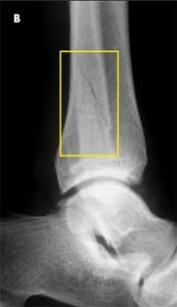 Based on reported rates of nonunion of 50% to 60% with conservative management (use of non weight-bearing cast for 6 to 8 weeks) for chronic fractures, the recommended treatment for chronic fractures