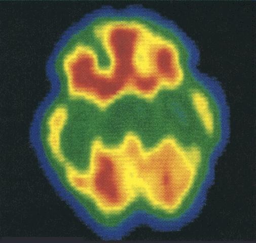 Anxiety Disorders PET Scan of brain of person with Obsessive/ Compulsive disorder