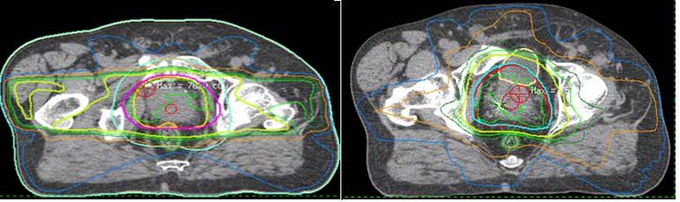6 A treatment planning study comparing VMAT with 3D Conformal Radiotherapy 399 observed with VMAT for PTV coverage. However, it can be seen in Fig.