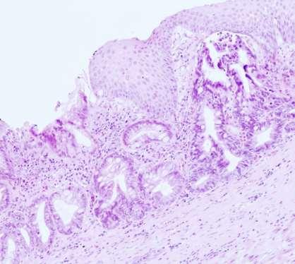 Post radiofrequency ablation biopsies/emrs Beware of buried glands!