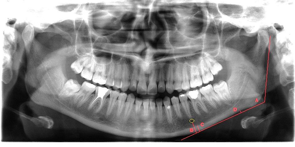 Correlation between mandibular radiomorphometric parameters three anatomical parameters (MCW, AD, and PMI) in subjects with low and high GAs.