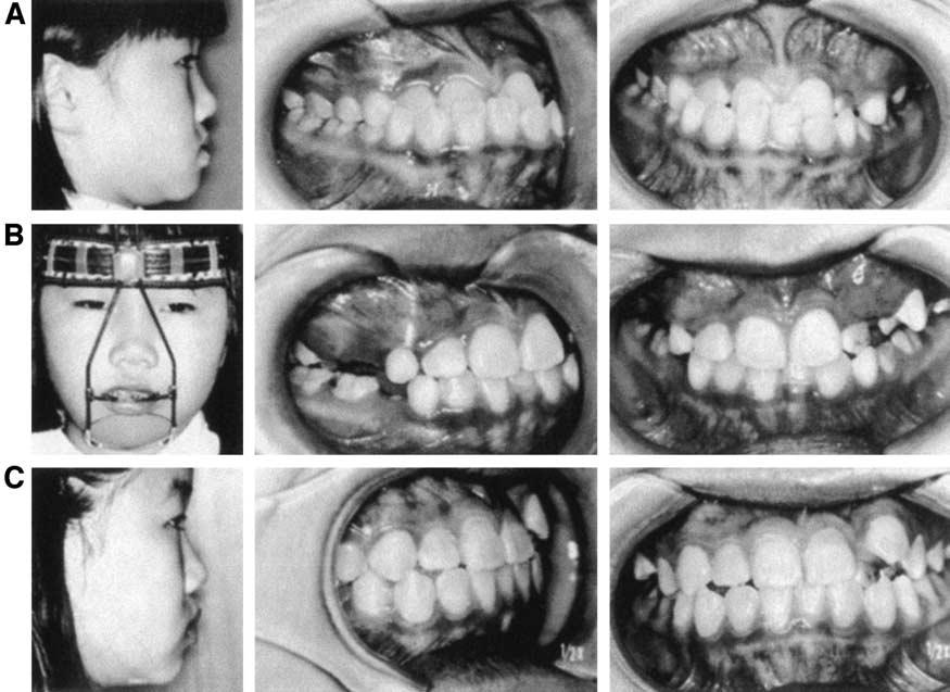 302 Ghiz, Ngan, and Gunel American Journal of Orthodontics and Dentofacial Orthopedics March 2005 Fig 1.
