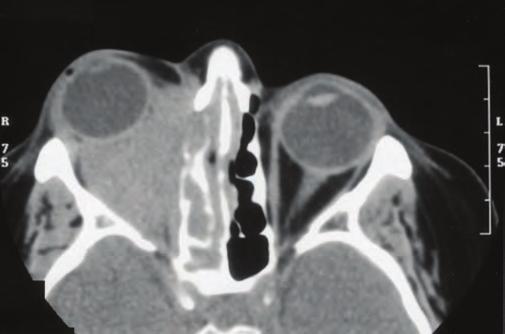 PART 15 Disorders of the Joints and Adjacent Tissues Figure e40-3 Bilateral ground-glass infiltrates