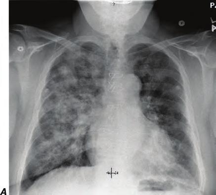 involving a segment of the right upper lobe due to bacterial pneumonia in an immunosuppressed patient