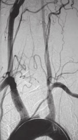 The patient had been diagnosed with biopsy-proven giant cell arteritis 10 years prior to presenting with