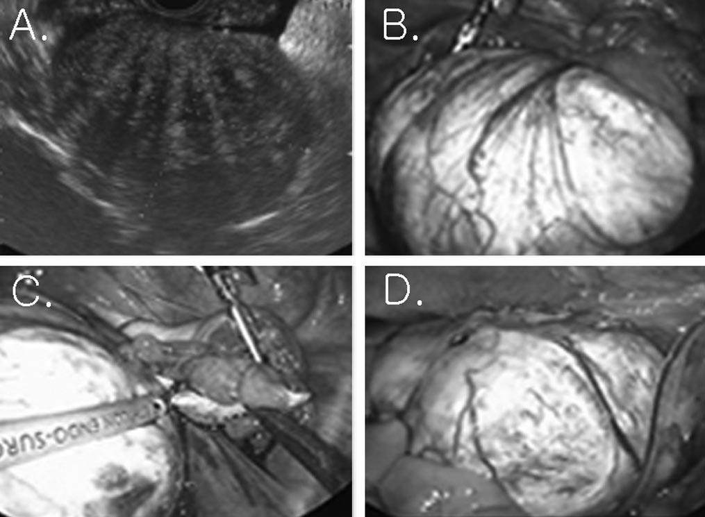 Laparoscopic Surgical Management and Clinical Characteristics of Ovarian Fibromas, Son CE et al. different from the previous results that reported the higher incidence on the left side. 2,3 Figure 1.
