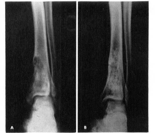DESMOPLASTIC FIBROMA OF BONE 207 Figure 1. A. Desmoplastic fibroma in the distal tibia showing irregular osteolgtic destructions. B. The same case 4 Uears after curettage now showing a clear cortical margin and a normalized though irregularly mineralized osseous structure.