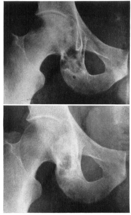 Figure 5. Desnioplastic fibroma giving rise to an irregular osteolutic change in the superior ischial ramus (upper picture).