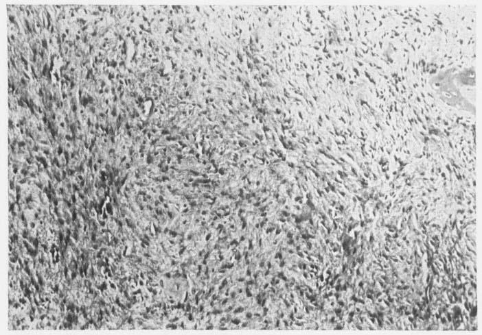 212 ULF NIISONNE & GUSTAF GOTHLIN Figure 6. Photomicrograph of desmoplastic fibroma. Homogeneous fibrous tissue with interlacing bundles of fibrillary cells (X 150).