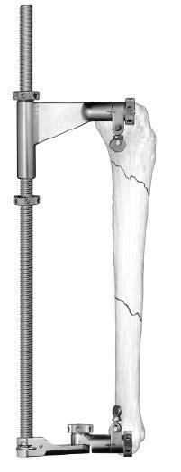 Any residual distraction can be corrected by applying the open compressors distal to the calcaneal pin, then compressing the fracture before final seating of the nail.