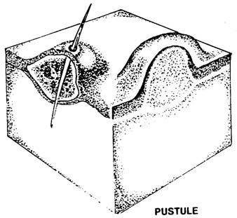 (8) Pustule. A pustule (figure 3-9) is a pus-filled lesion that can result from infection of vesicles or bullae.