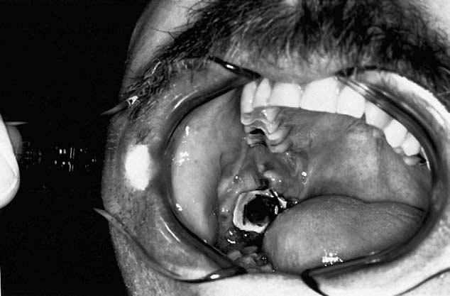 M. ANTHONY POGREL 1669 FIGURE 6. A mandibular keratocyst kept patent by suturing a cutdown nasopharyngeal airway into place.