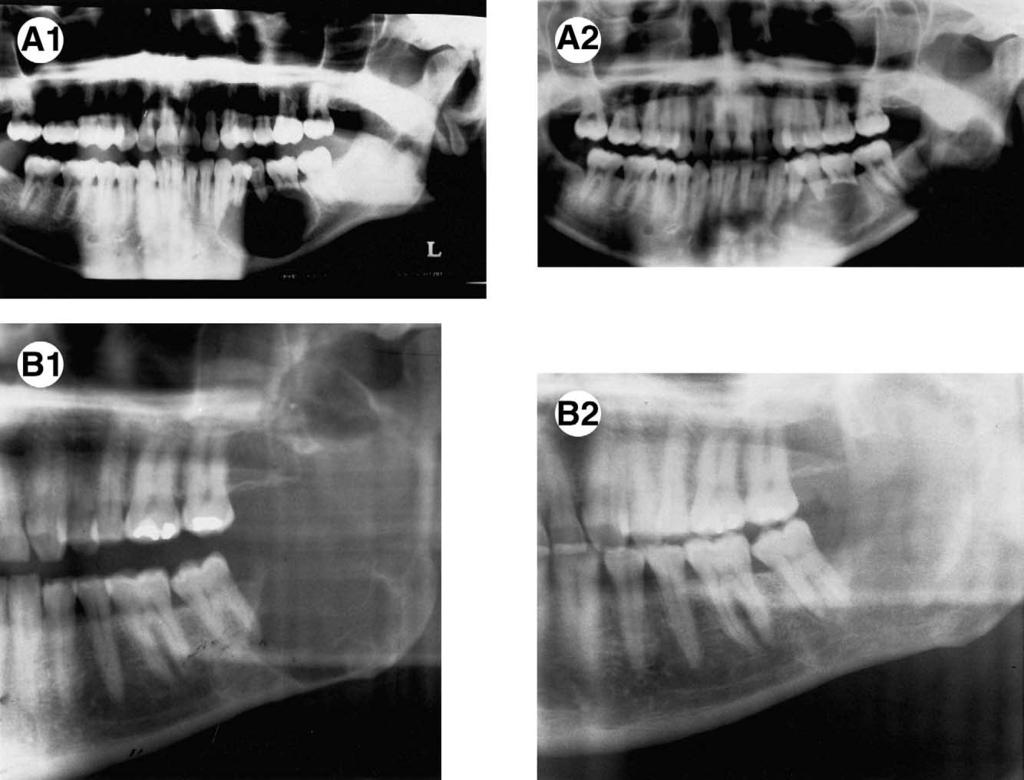 1670 DECOMPRESSION AND MARSUPIALIZATION OF KERATOCYSTS FIGURE 8. Radiographs for two cases of large keratocysts of the mandible which resolved following marsupialization.