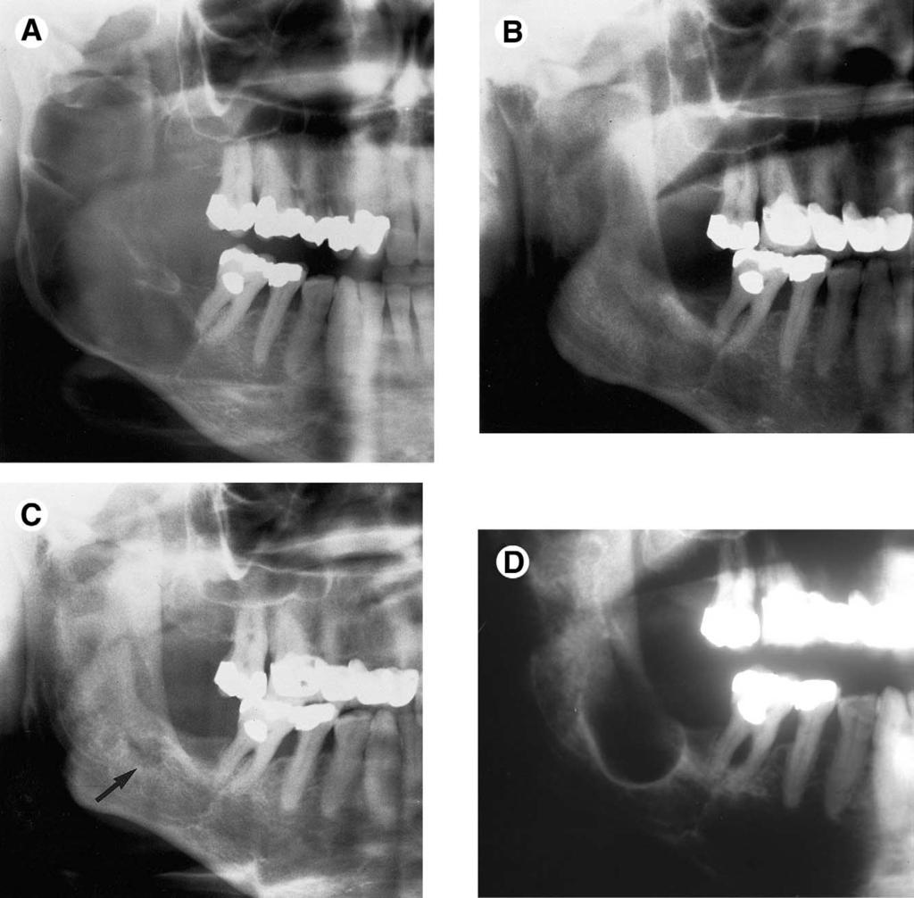 M. ANTHONY POGREL 1671 FIGURE 9. Recurrence of a keratocyst following marsupialization. A, Original radiograph showing large multilocular keratocyst of right angle of the mandible.