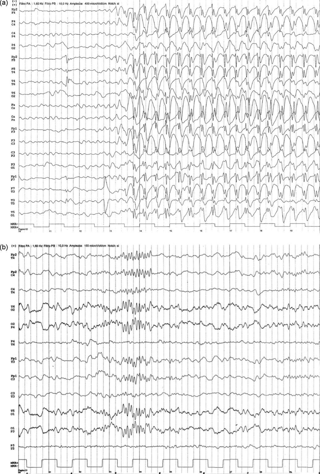 A. Verrotti et al. / Seizure 19 (2010) 368 372 371 Fig. 2. (a) The ictal EEG showing generalized spike wave activity during a typical absence, after 3 years from onset of G-ICOE.